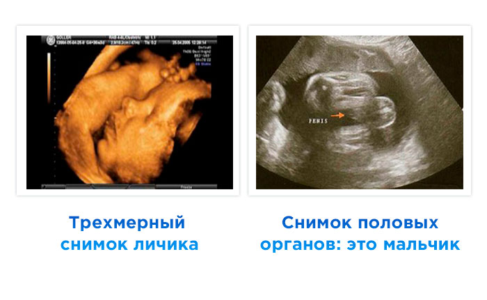 УЗИ на 36 неделе