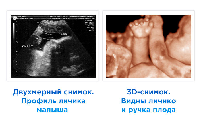 УЗИ снимки на 37 неделе