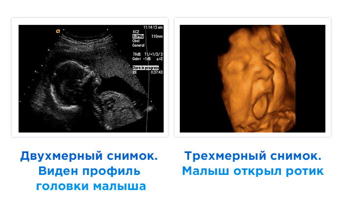 УЗИ плода на 38 неделе