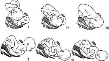 изгнание плода