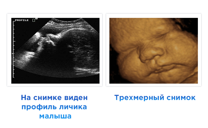 УЗИ на 40 неделе