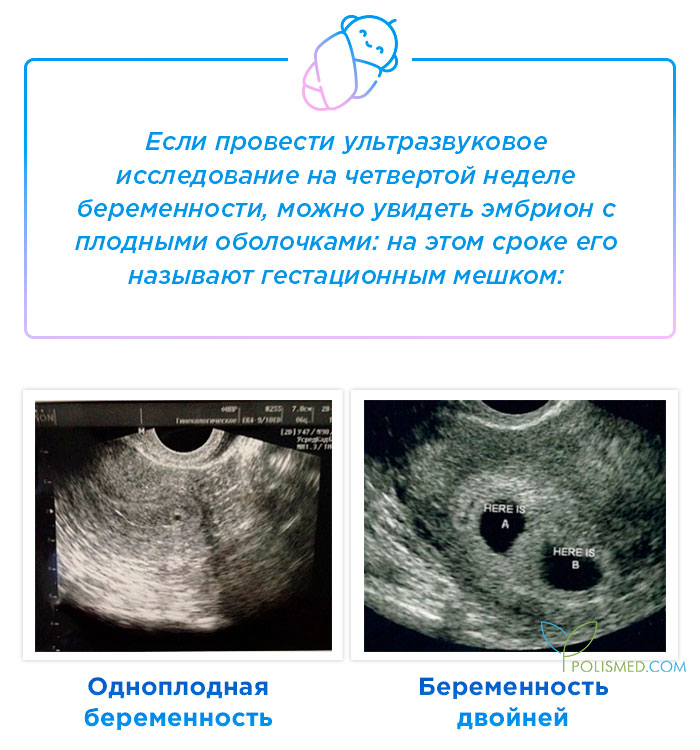 Если не тошнит на сроке 4 недели