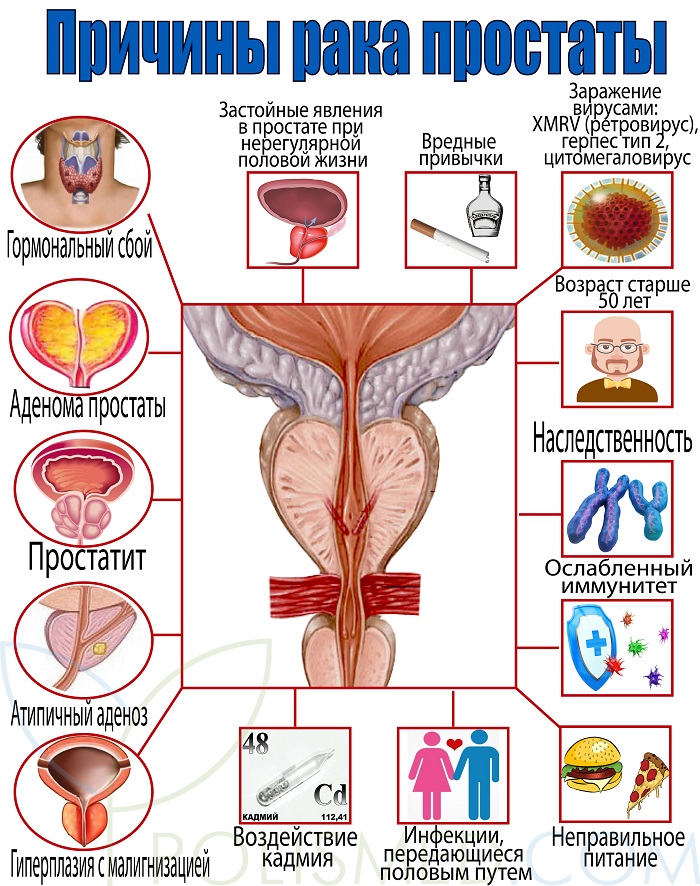 причины рака простаты