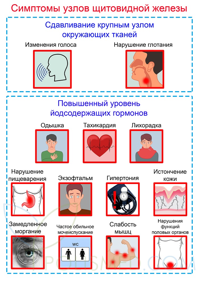 Симптомы узлов щитовидки