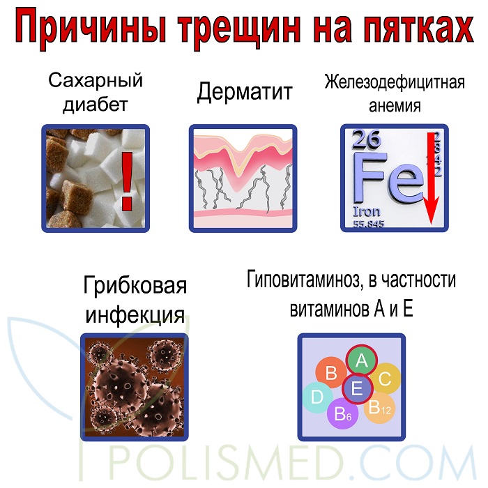 Причины трещин на пятках