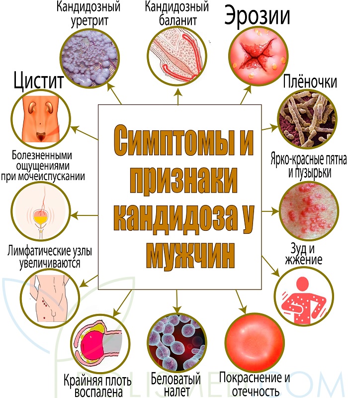 Симптомы и признаки кандидоза