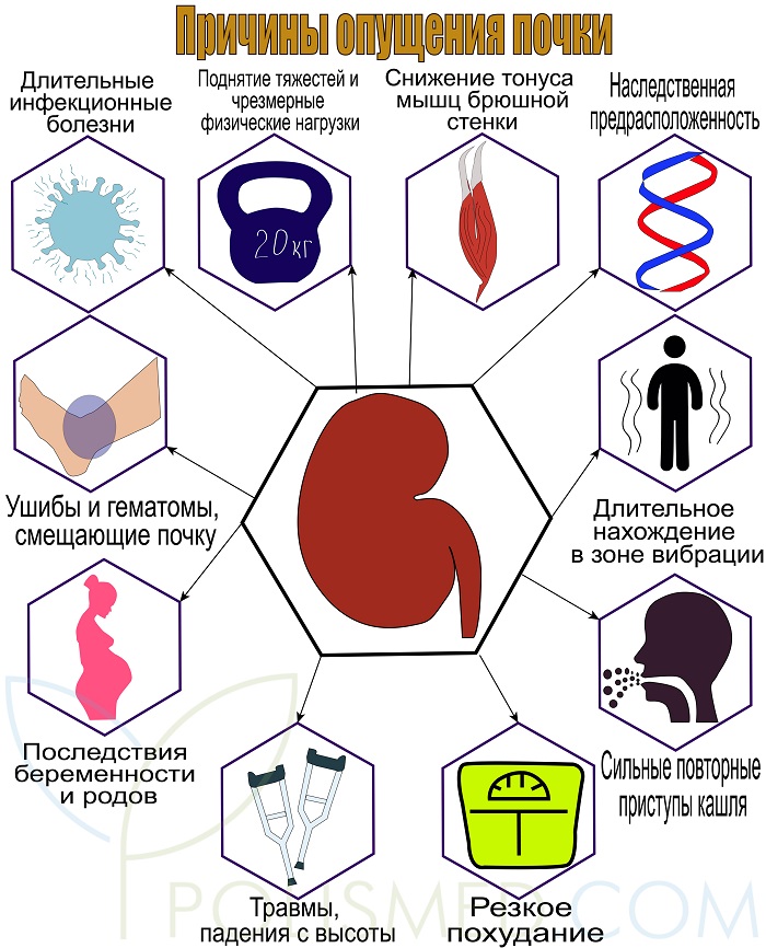 Причины опущения почки