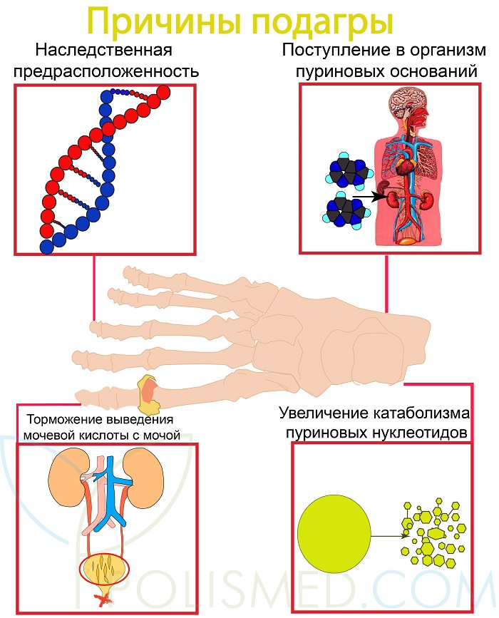 Причины подагры