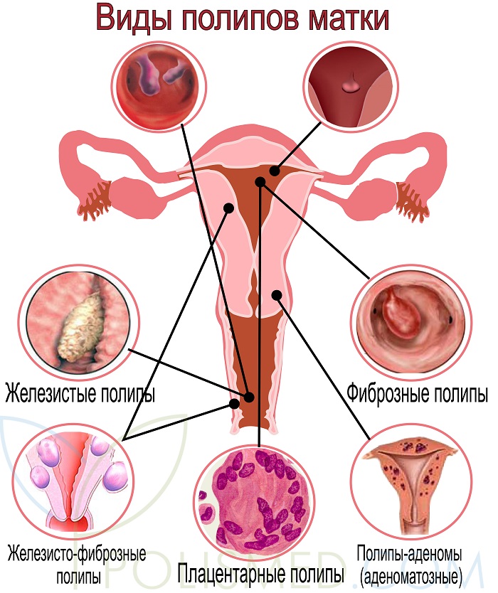 виды полипов матки