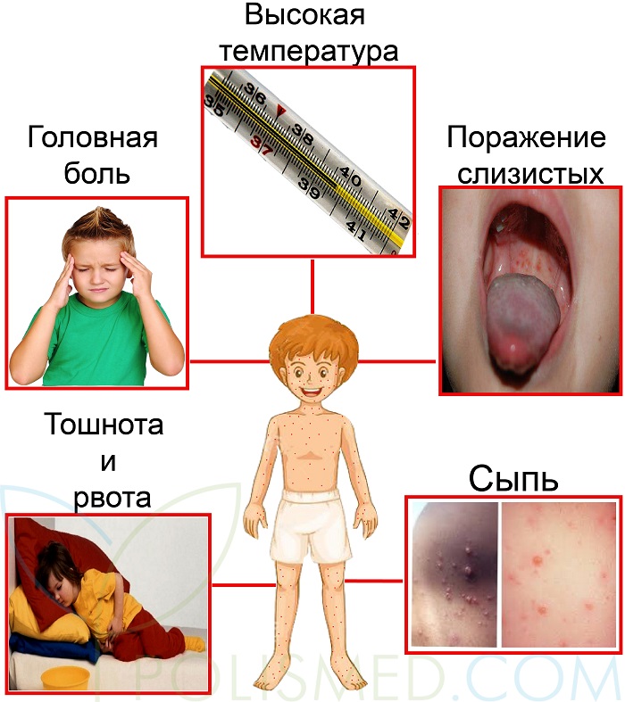 симптомы и признаки ветрянки