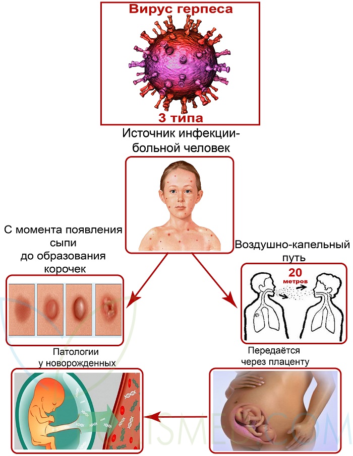 пути заражения ветрянкой