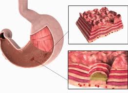 Язвы на слизистой оболочке желудка