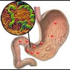 Язвы на слизистой оболочке желудка