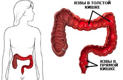 Колит кишечника у взрослых