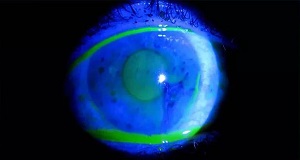 Выделения при синдроме сухого глаза