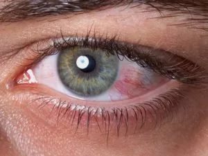 Выделения при синдроме сухого глаза