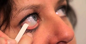 Синдром сухого глаза выделения из глаз