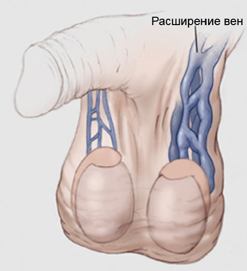 Варикоз на яичках