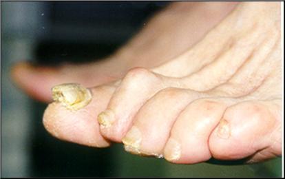 Пальцы на ногах при диабете