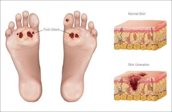 Диабет стопа ее признаки и лечение