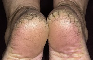 Раны на ногах при сахарном диабете между пальцами ног
