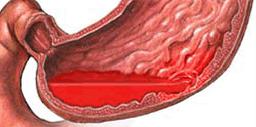 Признаки видов кровотечения артериальное венозное