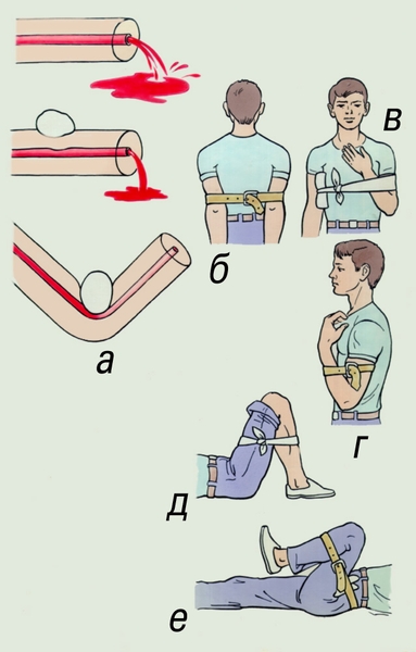 При артериальном кровотечении осколком стекла