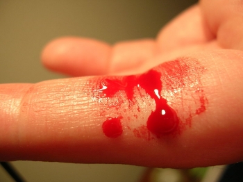 Артериальное кровотечение на руке