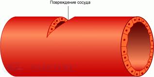 Основной способ временной остановки артериального кровотечения