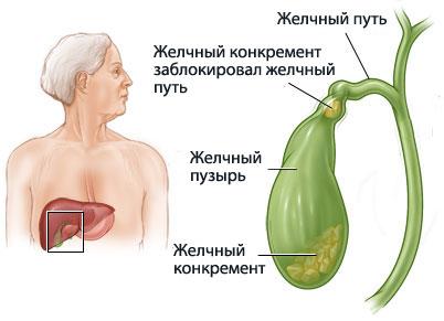 У меня колит правый бок в ребрах