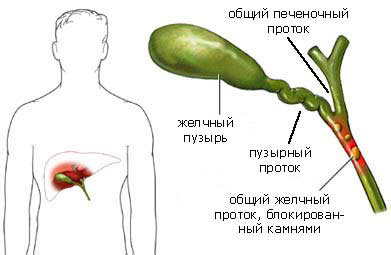 Колит и сильно болит в правом боку