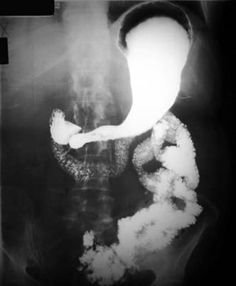Как проходит рентген желудка