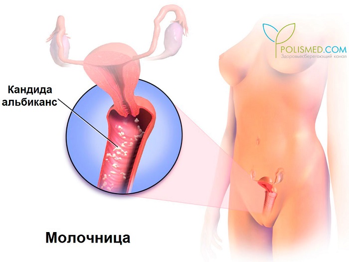 Кандидоз влагалища (молочница)