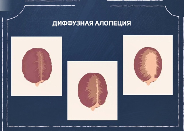 диффузная алопеция