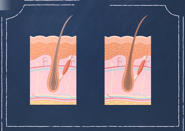 Повреждение фоликул