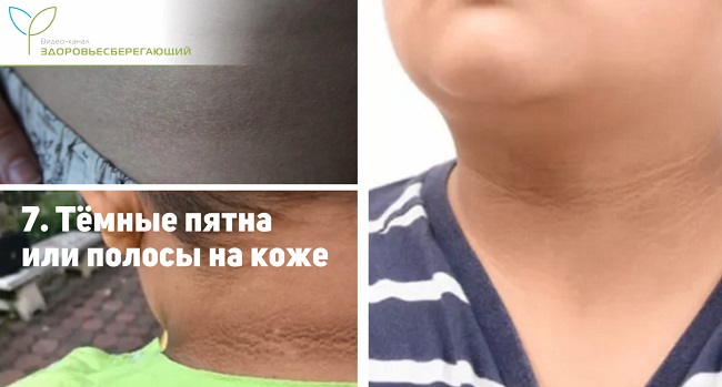 темные пятна на коже