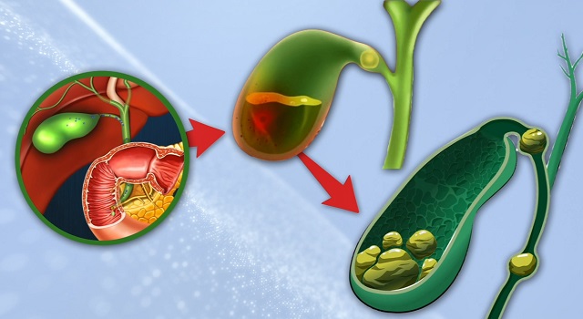 желчнокаменная болезнь