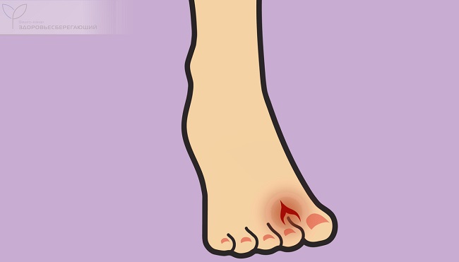 Неврома Мортона