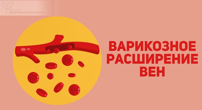 варикозное расширение вен на ногах