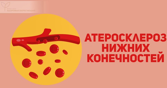 Атеросклероз