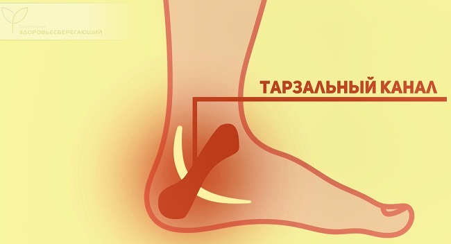 Тарзальный синдром