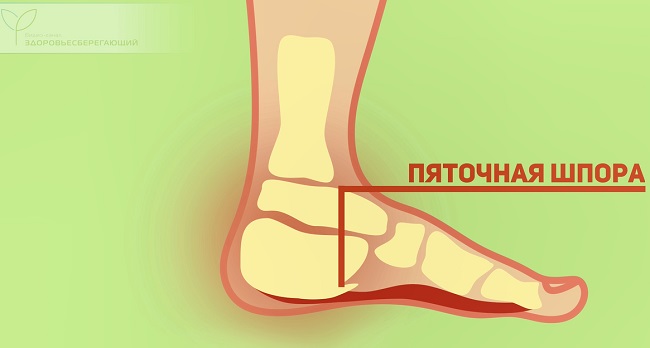 Плантарный фасциит