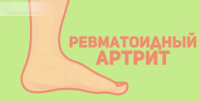 Ревматоидный артрит