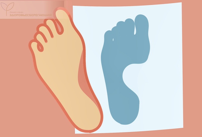 Нормальная форма стопы
