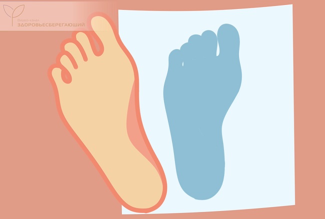 Плоскосопие