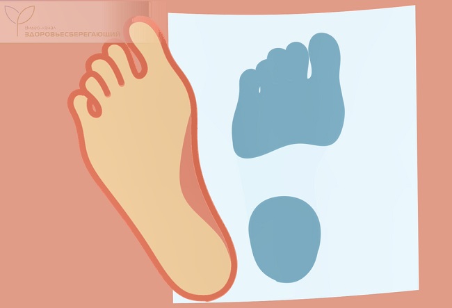 Высокий подъём