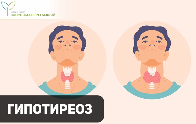 Гипотиреоз