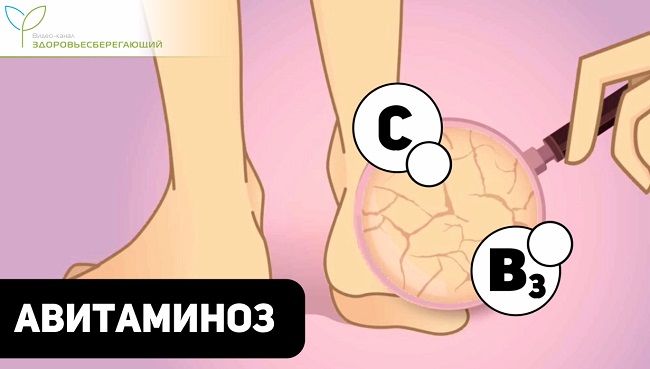 авитаминоз