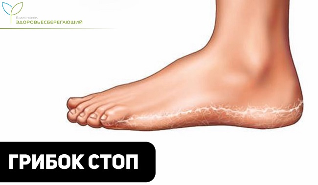 грибок стоп