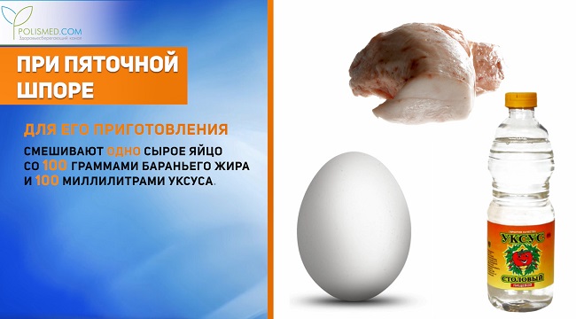 пяточная шпора